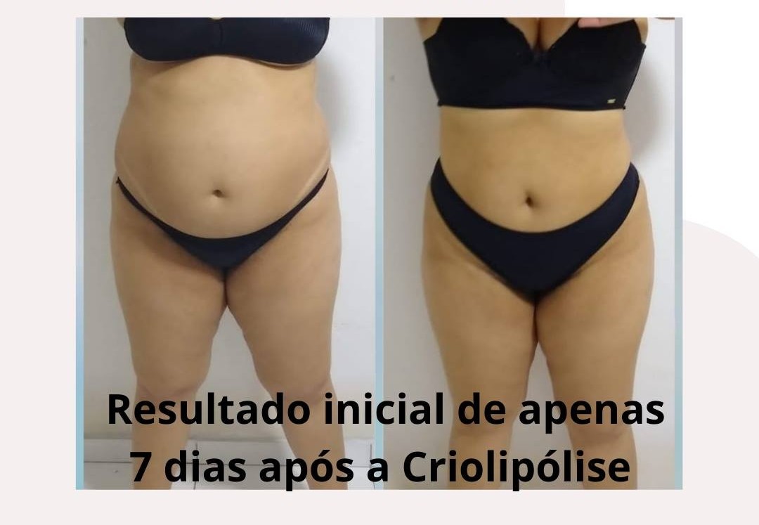 Evolução do tratamento de crio - Foto 2